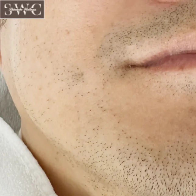 ヒゲ脱毛の症例写真:部位正面